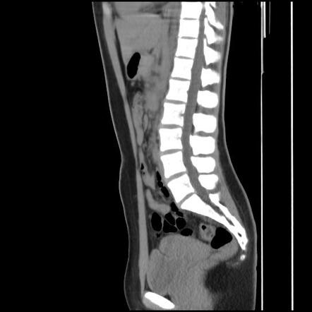 Ureterovesical junction calculus | Image | Radiopaedia.org