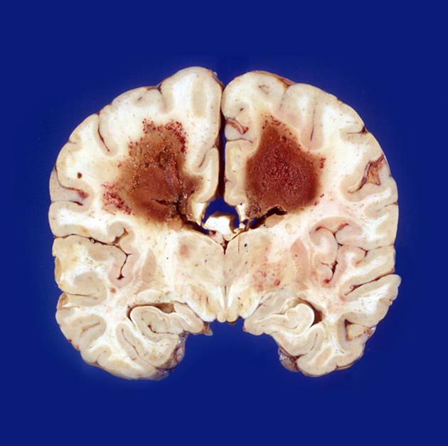 Lymphomas of the central nervous system | Radiology Reference 