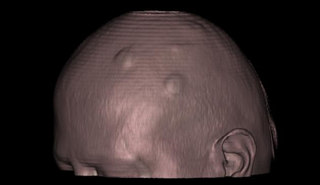 Multiple Scalp Trichilemmal Cysts Wens Radiology Case Radiopaedia Org