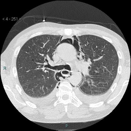 Hamman syndrome | Radiology Reference Article | Radiopaedia.org