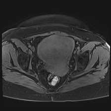 Adenomyosis vs fibroids | Image | Radiopaedia.org