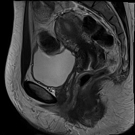 case study 65 endometriosis