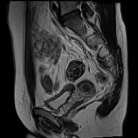 Endometriosis - urinary bladder & abdominal wall | Radiology Case ...