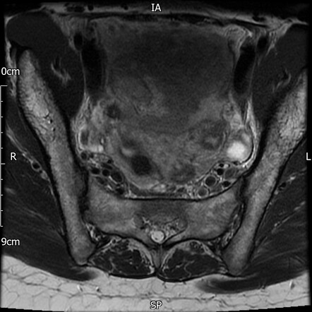 Unicornuate uterus | Radiology Case | Radiopaedia.org