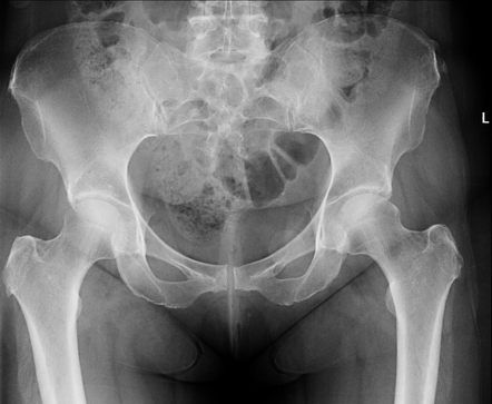 Triangles of the proximal femur | Radiology Case | Radiopaedia.org