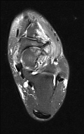 Mueller-Weiss syndrome | Radiology Case | Radiopaedia.org