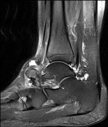 Mueller-Weiss syndrome | Image | Radiopaedia.org