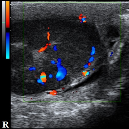 Primary testicular lymphoma | Image | Radiopaedia.org