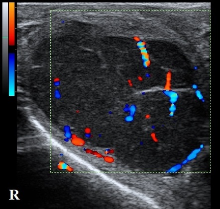 Primary testicular lymphoma | Image | Radiopaedia.org