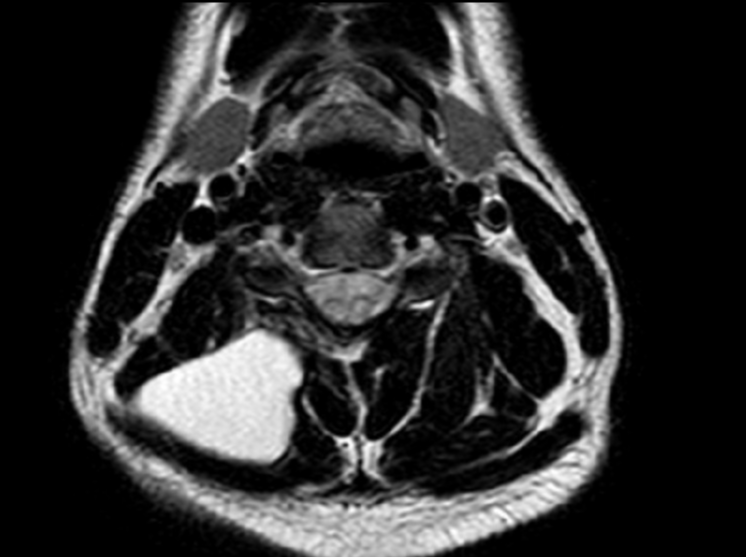 Myelomalacia and pseudomeningocele Image