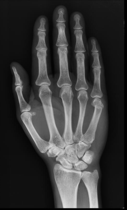 Boxer's fracture | Image | Radiopaedia.org