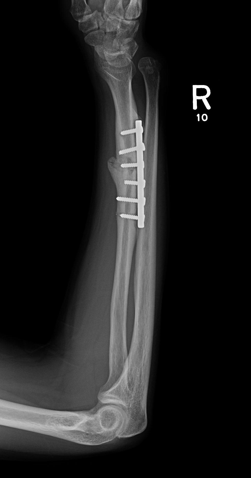 Hypertrophic nonunion | Image | Radiopaedia.org