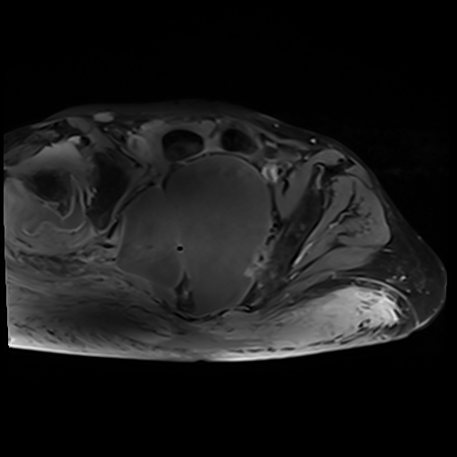 Anterior sacral meningocele | Image | Radiopaedia.org