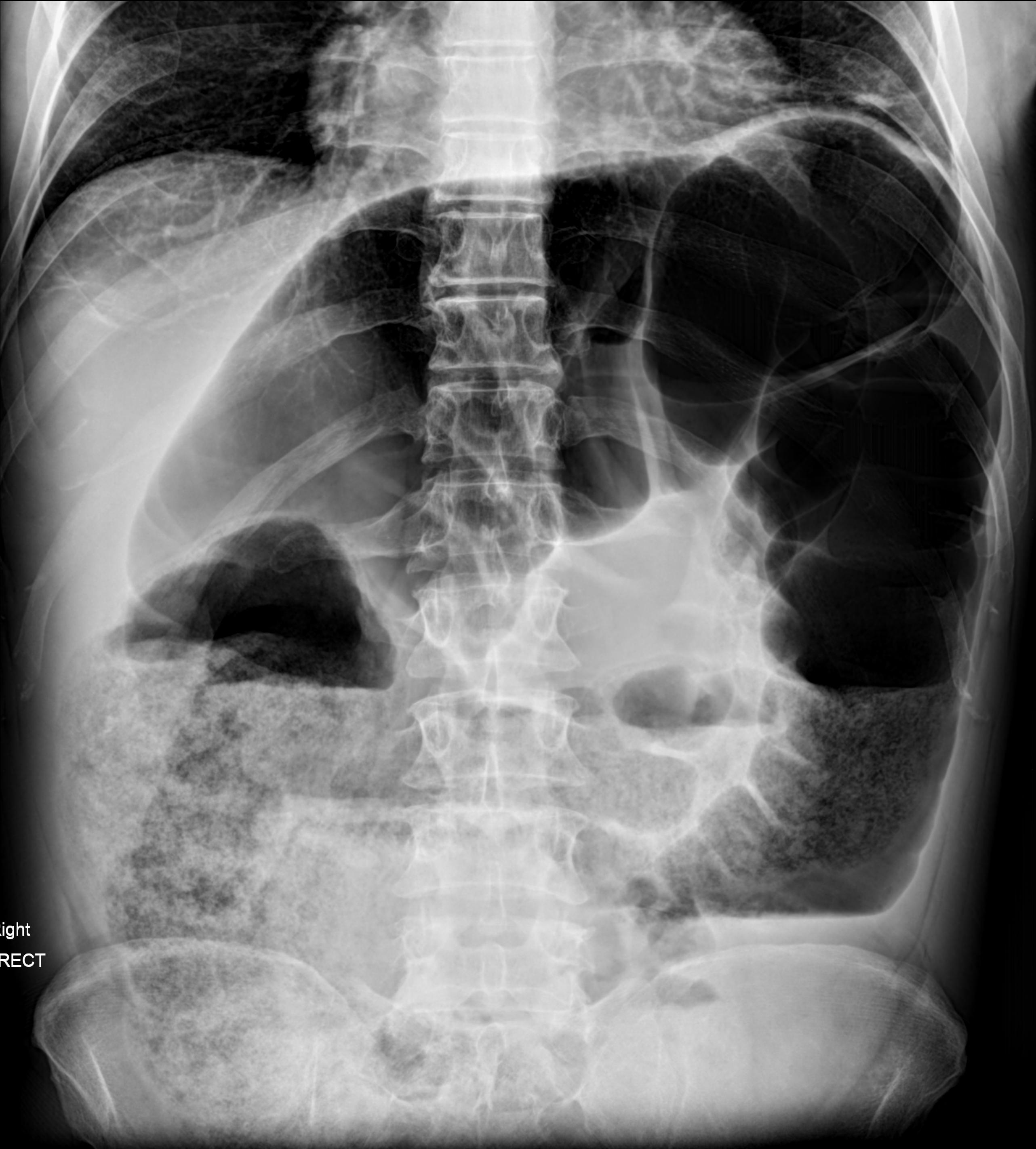 Large bowel obstruction | Image | Radiopaedia.org