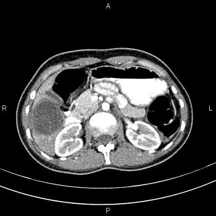 Hepatic hydatid cyst | Radiology Case | Radiopaedia.org