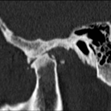 Osteoarthritis of the temporomandibular joint | Radiology Reference