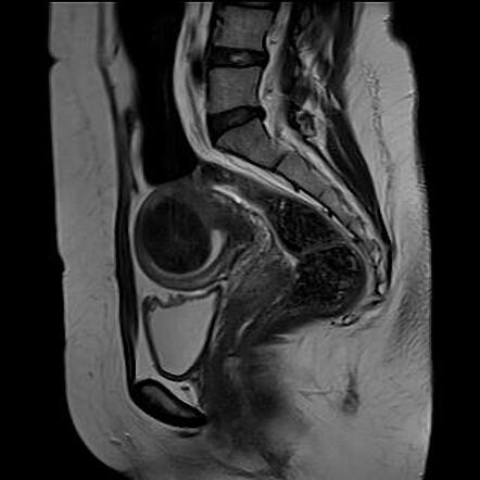 FIGO classification system for uterine leiomyoma | Radiology Reference ...