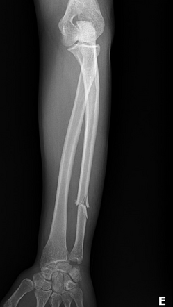 Isolated Ulnar Shaft Fracture - Bilateral | Radiology Case ...