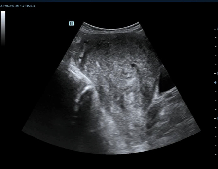 Adenomyosis | Radiology Case | Radiopaedia.org