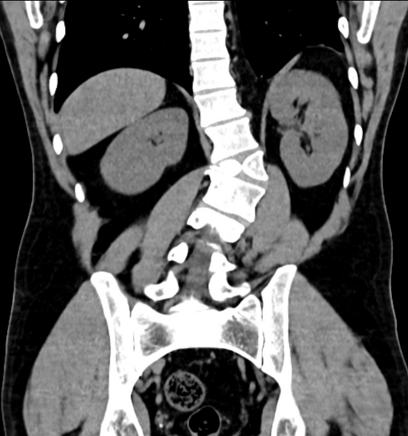 Butterfly vertebra | Radiology Reference Article | Radiopaedia.org