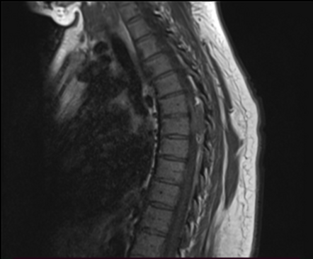 Intraspinal hematoma and dural fistula | Image | Radiopaedia.org