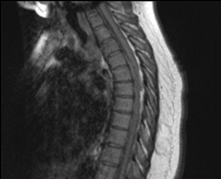 Intraspinal hematoma and dural fistula | Image | Radiopaedia.org