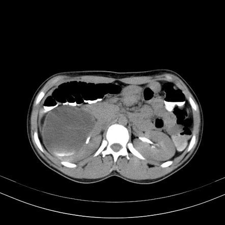 Calyceal diverticulum | Radiology Case | Radiopaedia.org