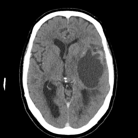 Glioblastoma with primitive neuronal components | Radiology Case ...