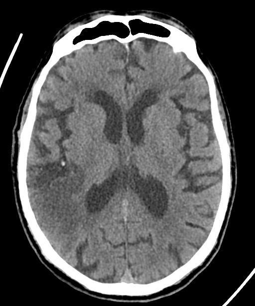 Acute MCA stroke | Image | Radiopaedia.org