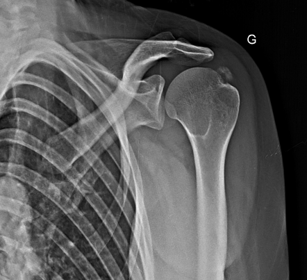 Calcific Tendinitis Radiology Case Radiopaedia Org