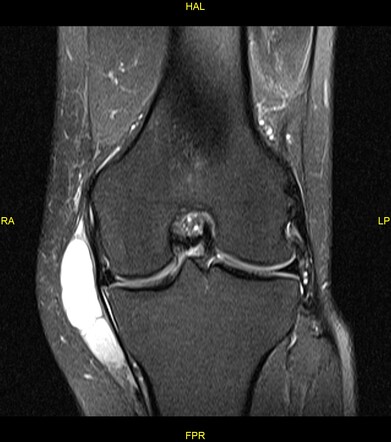 Parameniscal cyst | Radiology Case | Radiopaedia.org