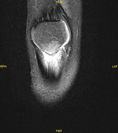 Jumper's knee | Image | Radiopaedia.org