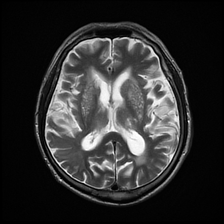 État criblé with acute right middle cerebal artery infarct | Radiology ...