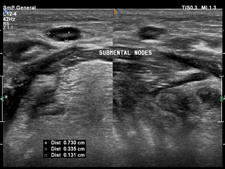 Acute sialadenitis | Image | Radiopaedia.org