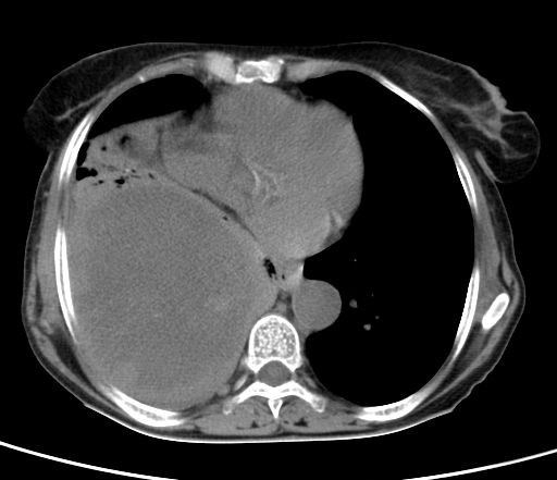 Primary sarcomatoid carcinoma of lung | Image | Radiopaedia.org