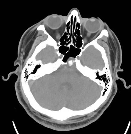 Ecchordosis physaliphora | Radiology Reference Article | Radiopaedia.org