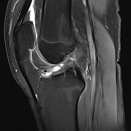 Ramp lesion | Radiology Case | Radiopaedia.org