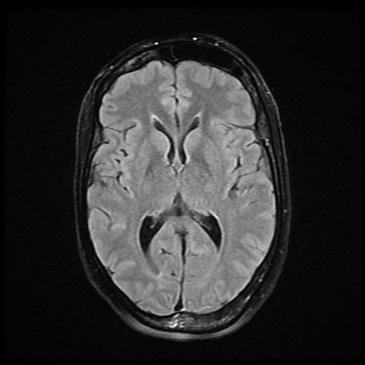 Sturge-Weber syndrome | Image | Radiopaedia.org