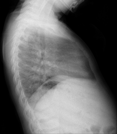 Bifid rib | Image | Radiopaedia.org