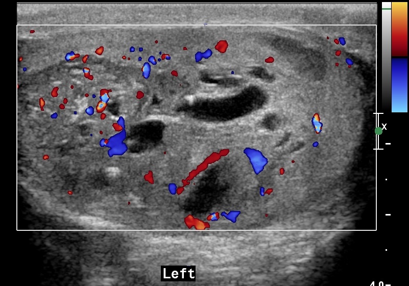 Testicular Mixed Germ Cell Tumor Image 6933