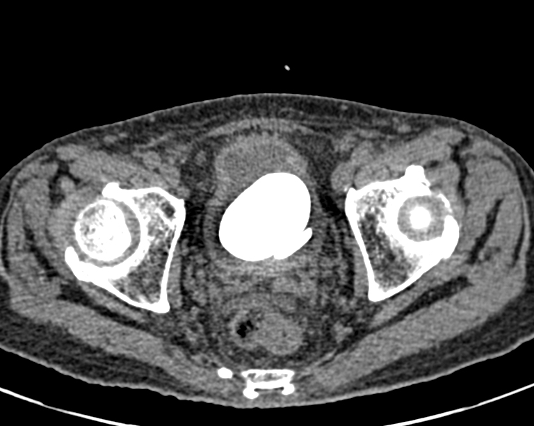 Urinary bladder calculus | Image | Radiopaedia.org