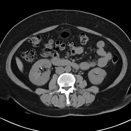 Normal split bolus study | Image | Radiopaedia.org