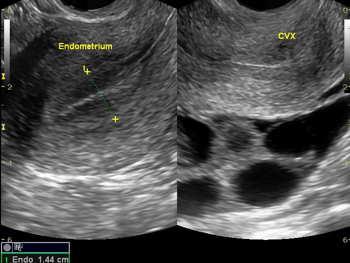 Follicular tracking | Image | Radiopaedia.org