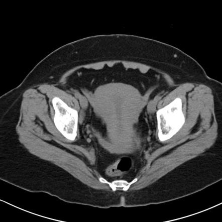 Round ligament of the uterus | Radiology Reference Article