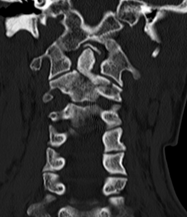 Anderson and D'Alonzo type III complex odontoid fracture | Radiology ...