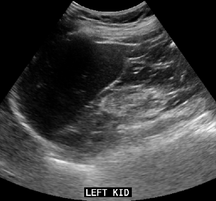 Peripelvic cysts and hydronephrosis | Image | Radiopaedia.org