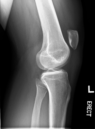 Patella alta | Image | Radiopaedia.org