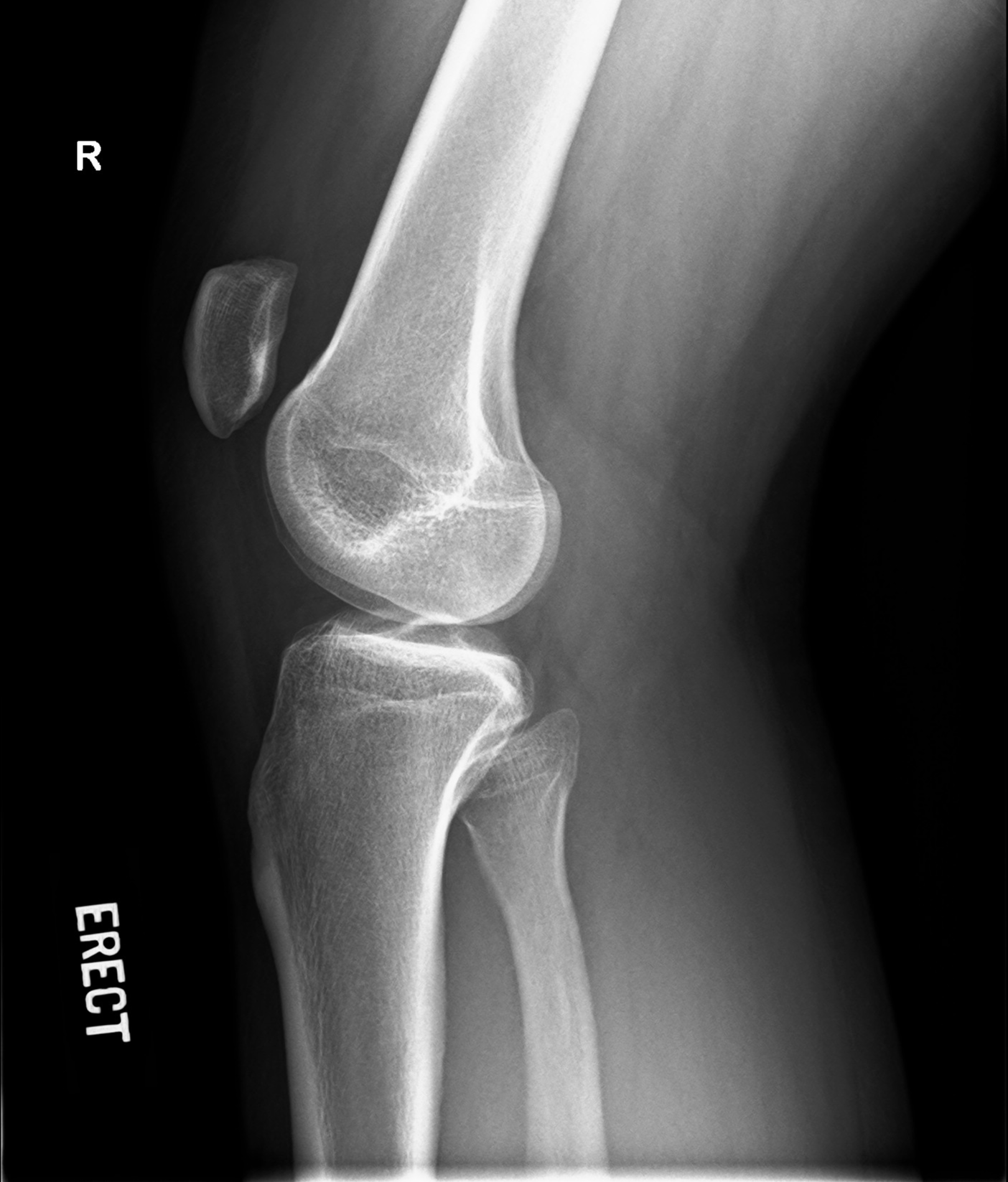 Patella alta | Image | Radiopaedia.org