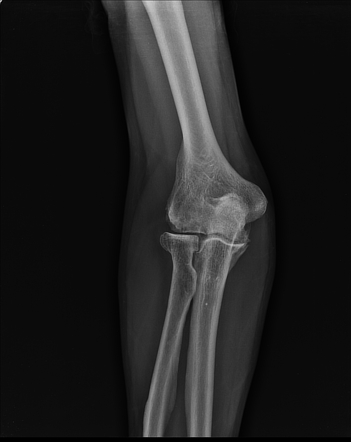 Ulnar intraneural ganglion cyst - elbow | Image | Radiopaedia.org