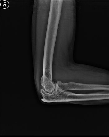 Ulnar intraneural ganglion cyst - elbow | Image | Radiopaedia.org